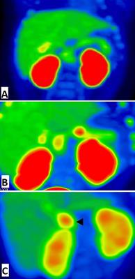 Differential Morphological Diagnosis of Various Forms of Congenital Hyperinsulinism in Children